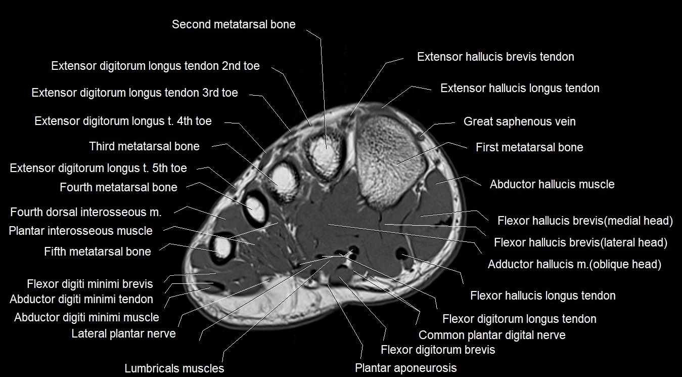 MRI 3T foot axial cross sectional anatomy image 15.webp